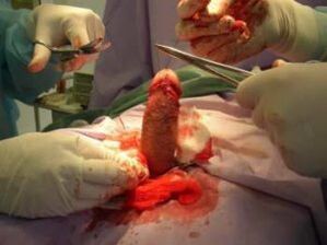operatie de marire a penisului